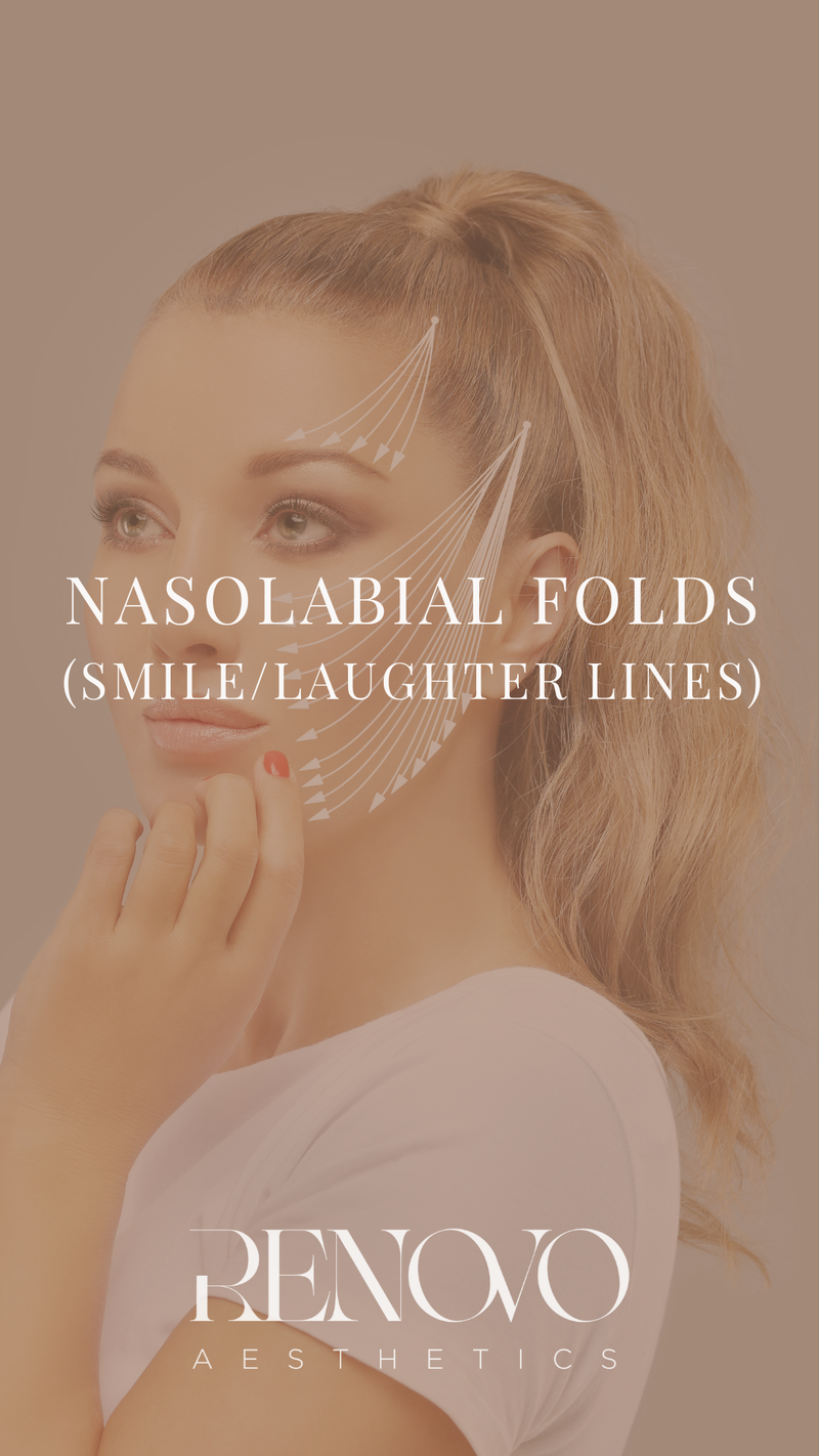 Nasolabial Folds (Smile/Laughter Lines)