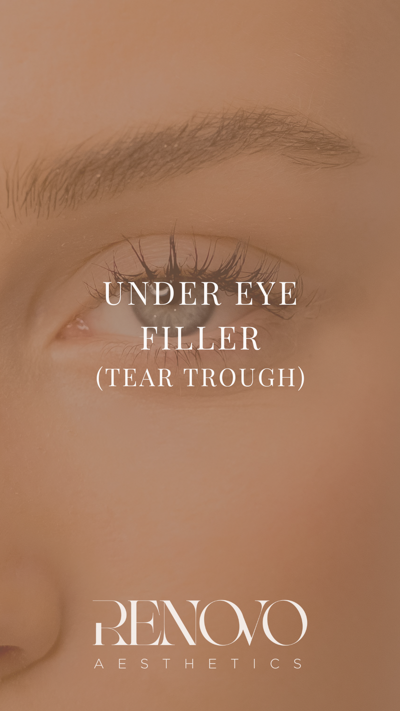 Under Eye Filler (Tear Trough)